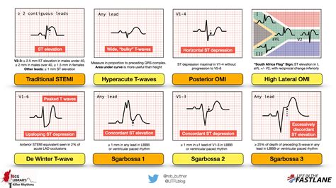 ecg bella|EKG Library • LITFL • ECG Library Basics .